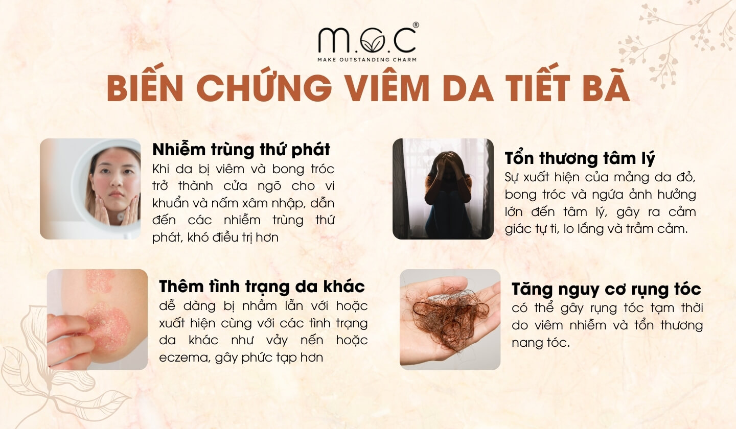 Những biến chứng của viêm da tiết bã