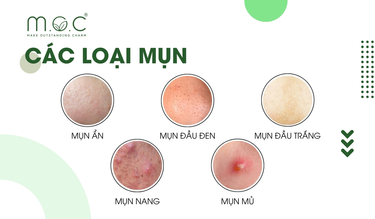 Các loại mụn thường gặp như mụn ẩn, mụn đầu trắng, mụn đầu đen, mụn cám,..