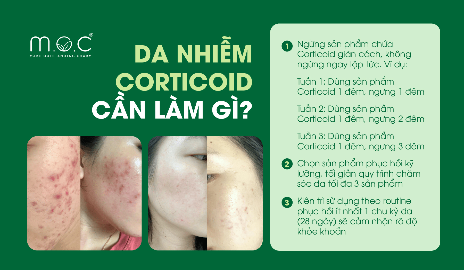 Cần làm gì khi da nhiễm Corticoid?