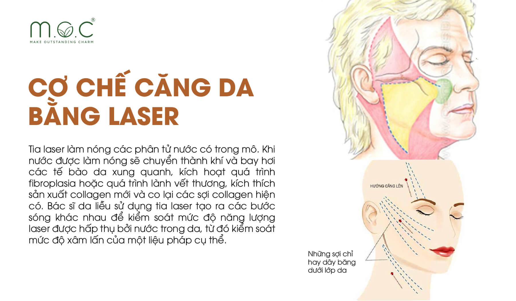 Cơ chế căng da mặt bằng laser