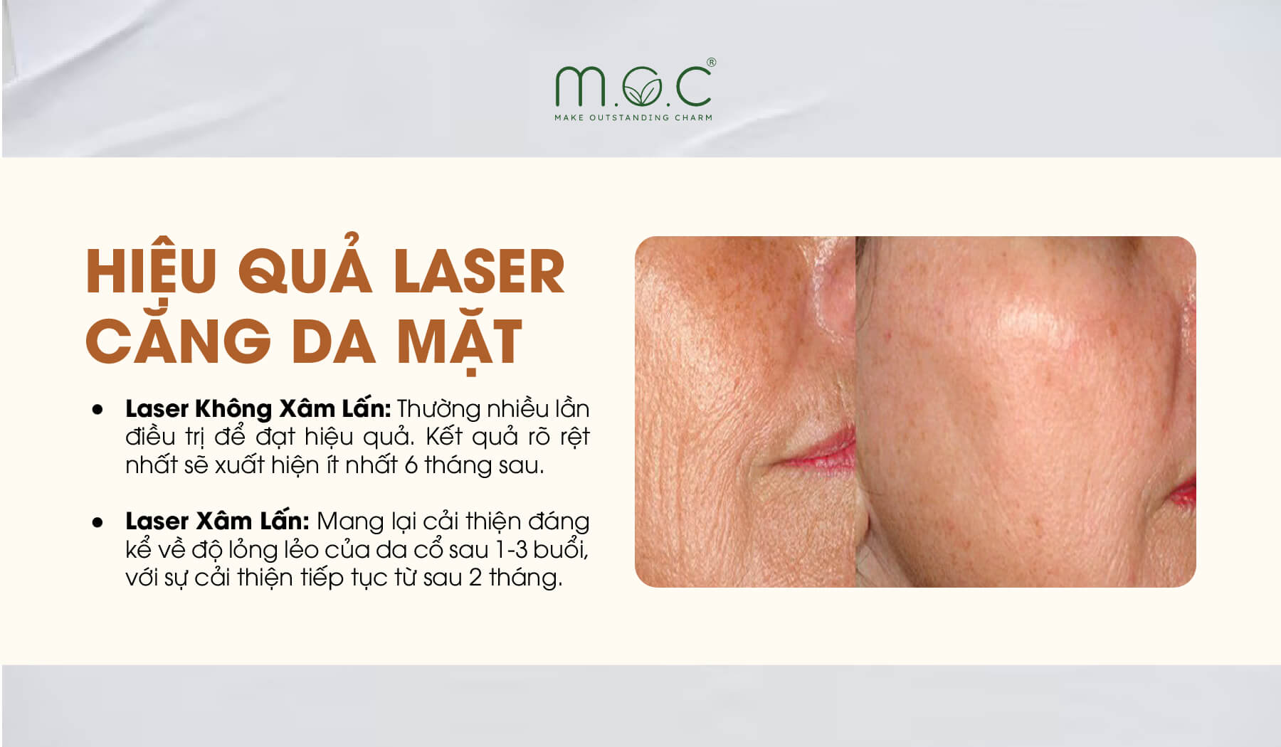 Những lợi ích khi căng da mặt bằng laser