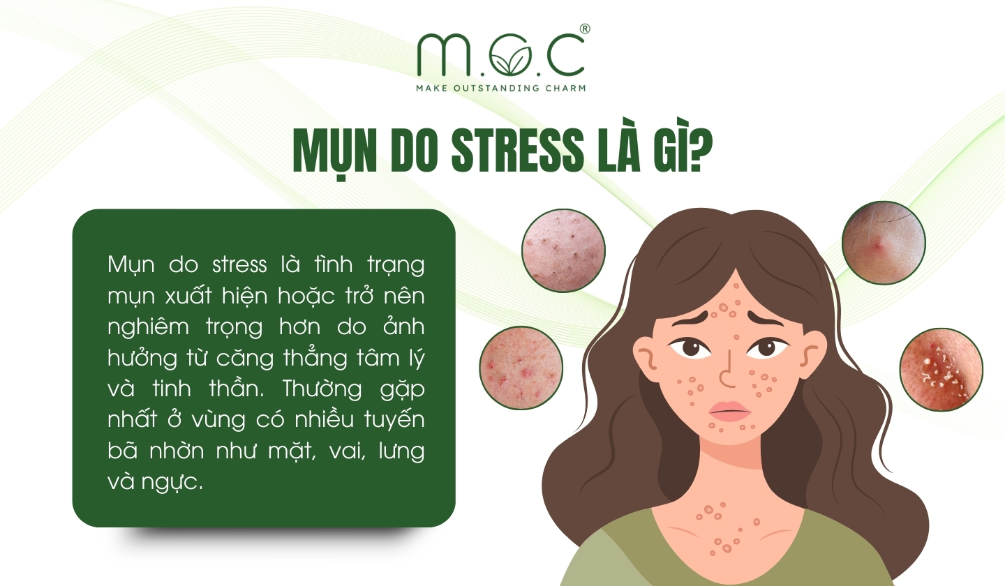 Mụn do stress (căng thẳng) là gì?