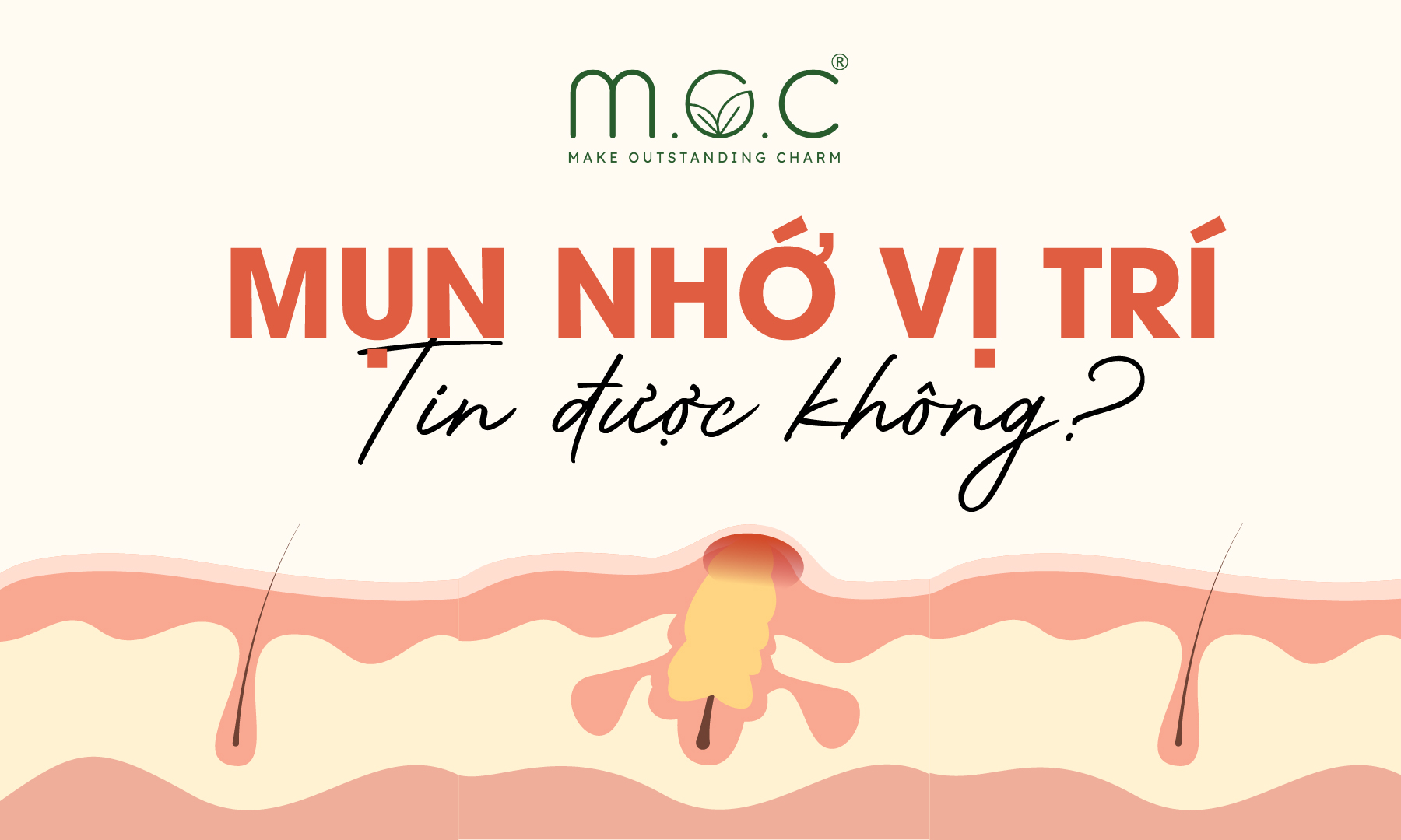 Mụn viêm mọc cùng vị trí