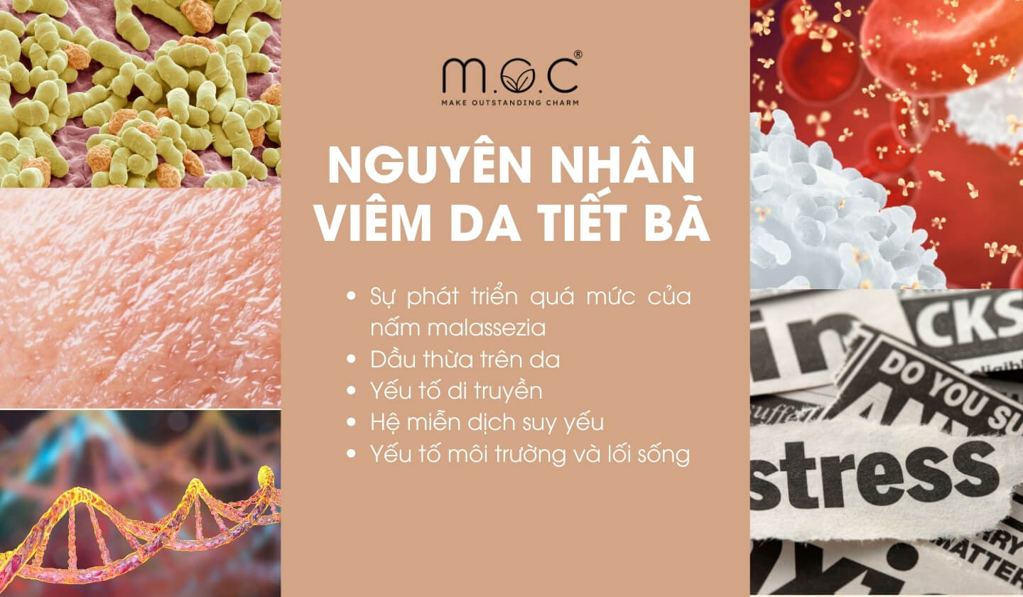 Các nguyên nhân gây viêm da tiết bã nhờn