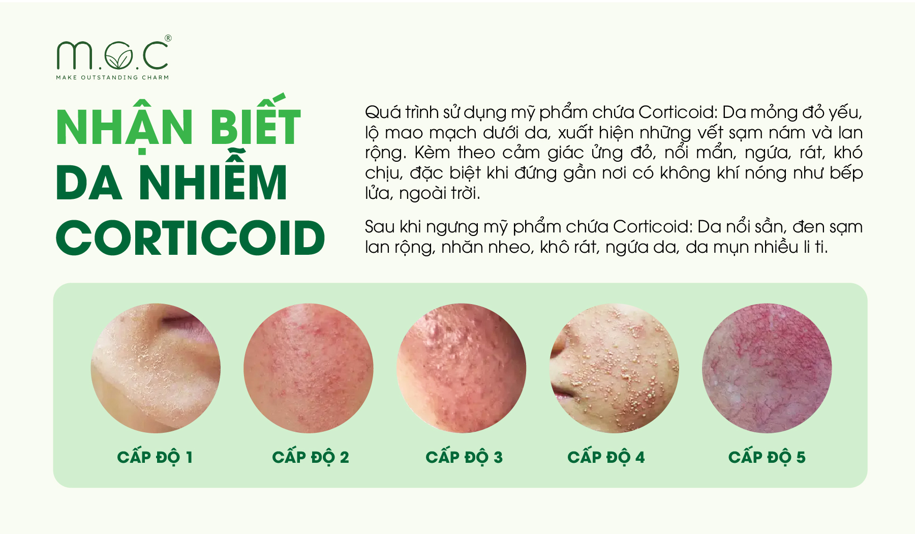 Nhận biết da nhiễm Corticoid