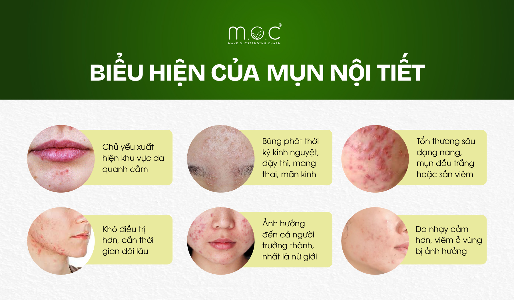 Những dấu hiệu nhận diện mụn nội tiết