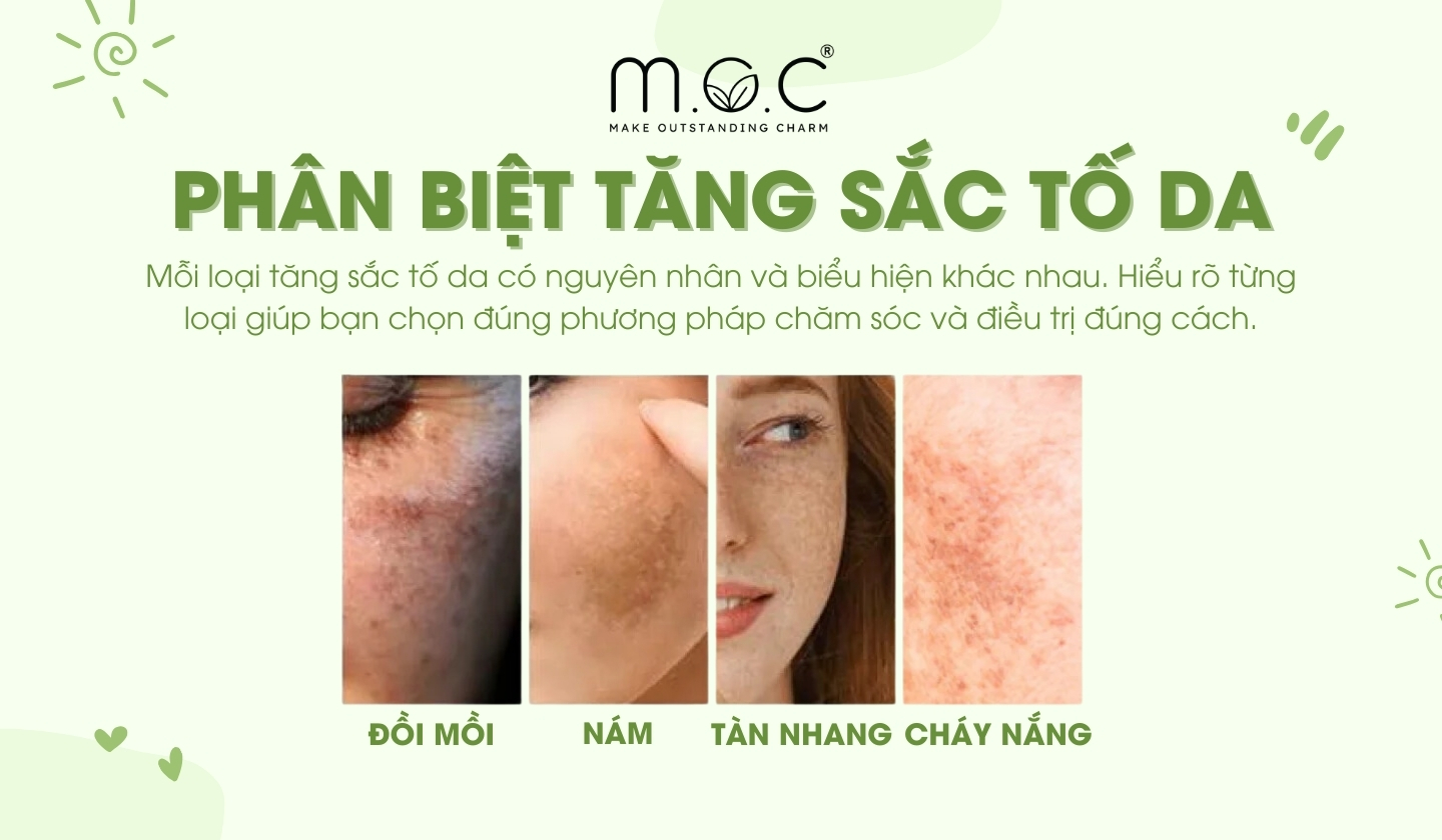 Phân biệt các dạng tăng sắc tố da