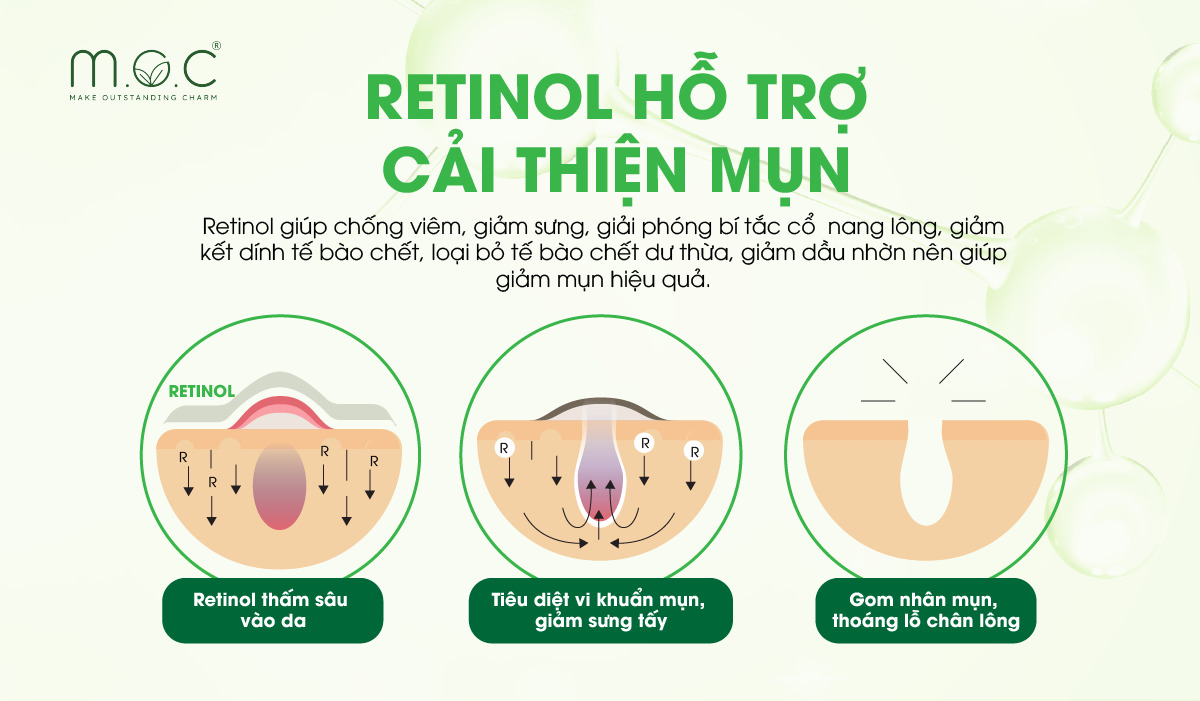 Retinol hỗ trợ cải thiện mụn hiệu quả