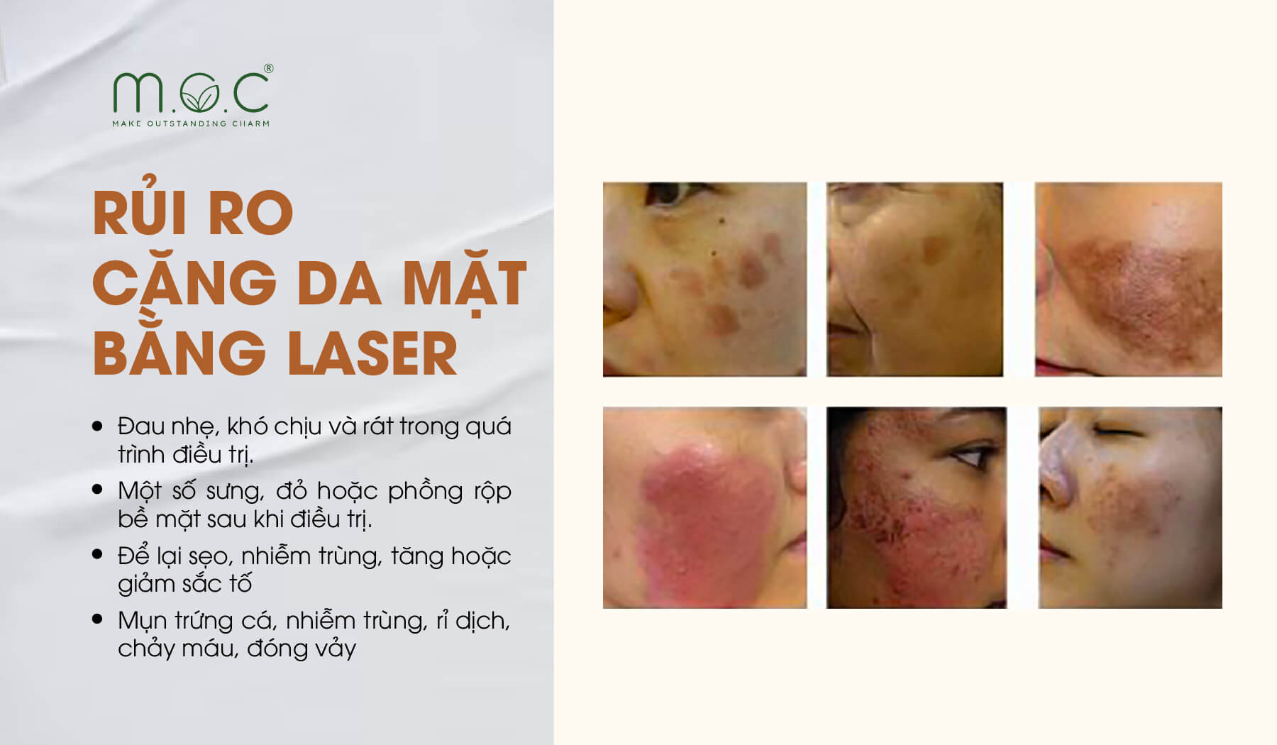 Những rủi ro khi căng da mặt bằng laser