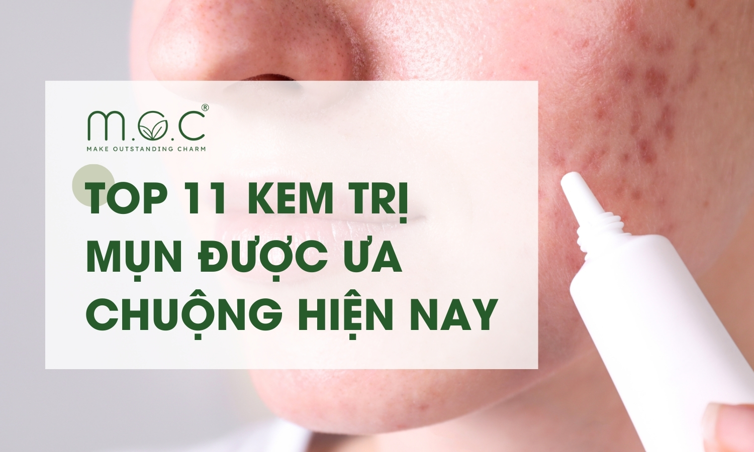 Top 11 kem trị mụn được ưa chuộng