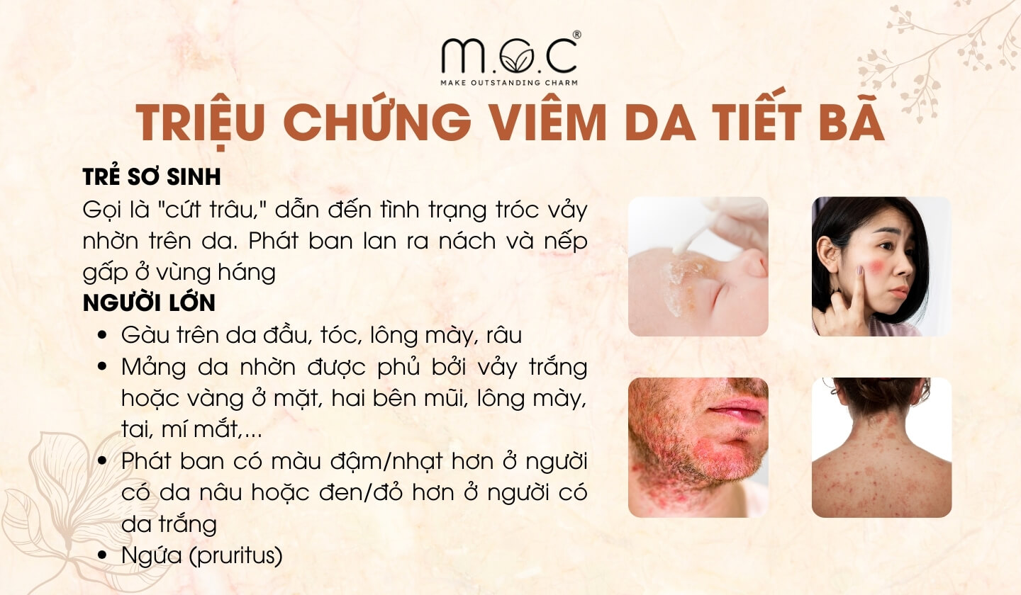 Những triệu chứng gây viêm da tiết bã