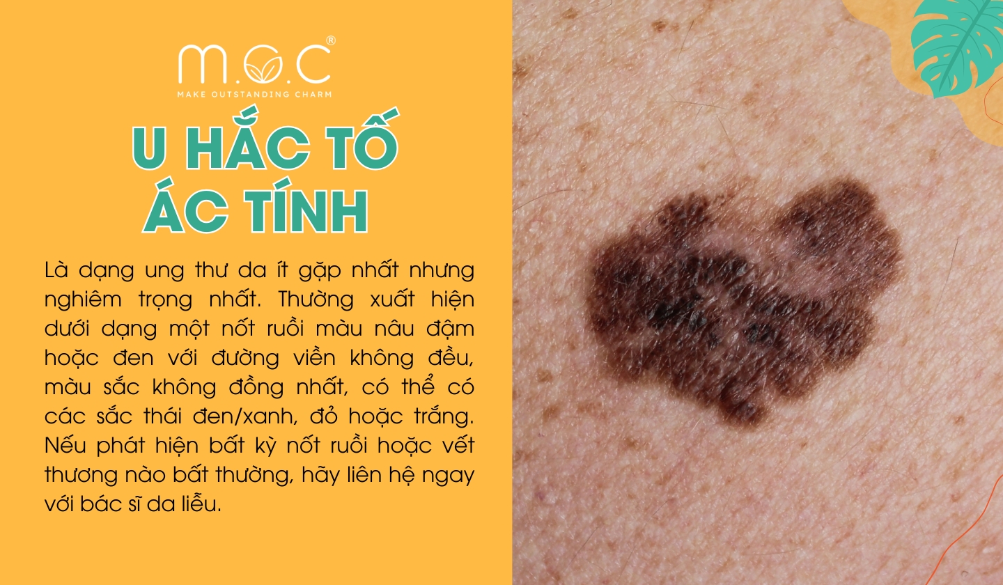 U hắc tố ác tính (Melanoma) là dạng ung thư da ít gặp nhất nhưng nghiêm trọng nhất