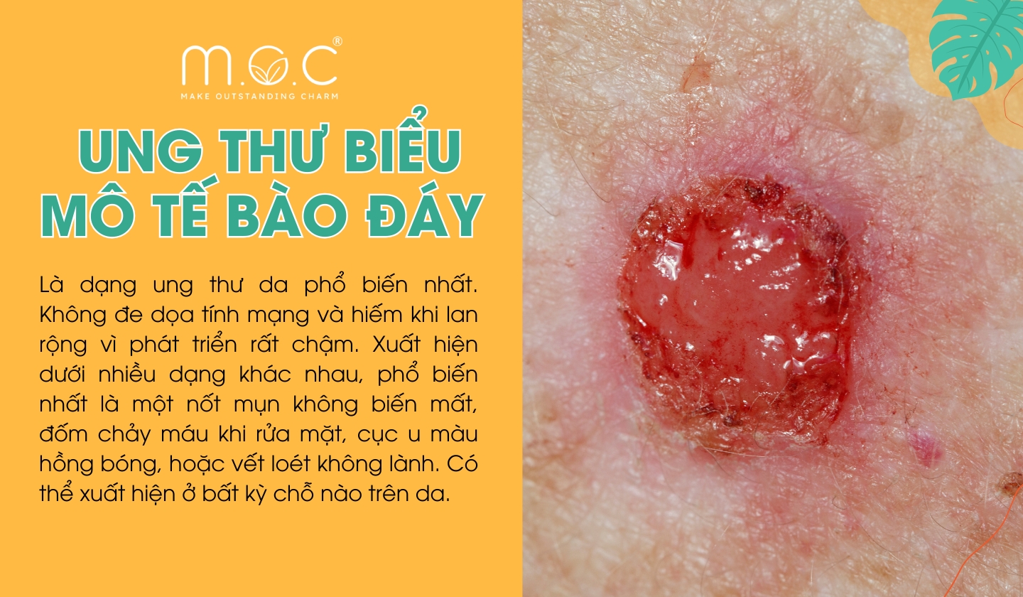 Ung thư biểu mô tế bào đáy (Basal cell carcinoma - BCC) là dạng ung thư da phổ biến nhất.