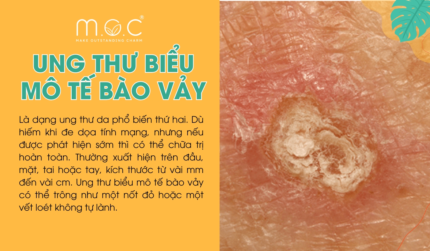 Ung thư biểu mô tế bào vảy (Squamous Cell Carcinoma - SCC) là dạng ung thư da phổ biến thứ hai