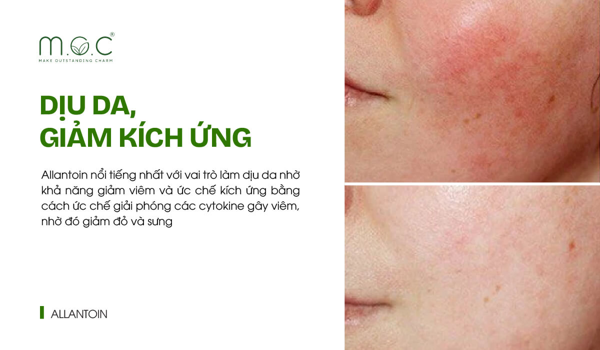 Allantoin làm dịu da, giảm kích ứng