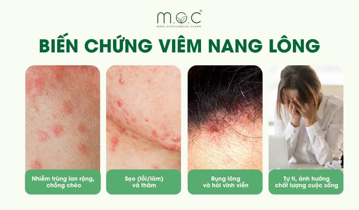 Các biến chứng do viêm nang lông