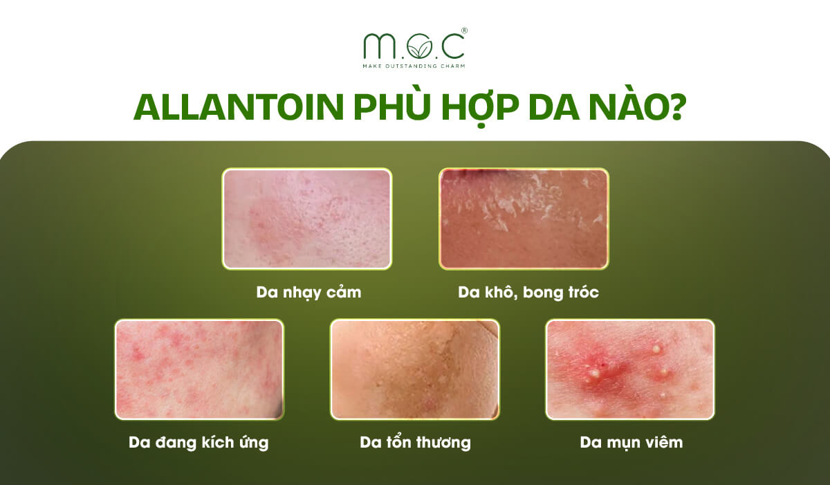 Allantoin phù hợp những làn da nào?