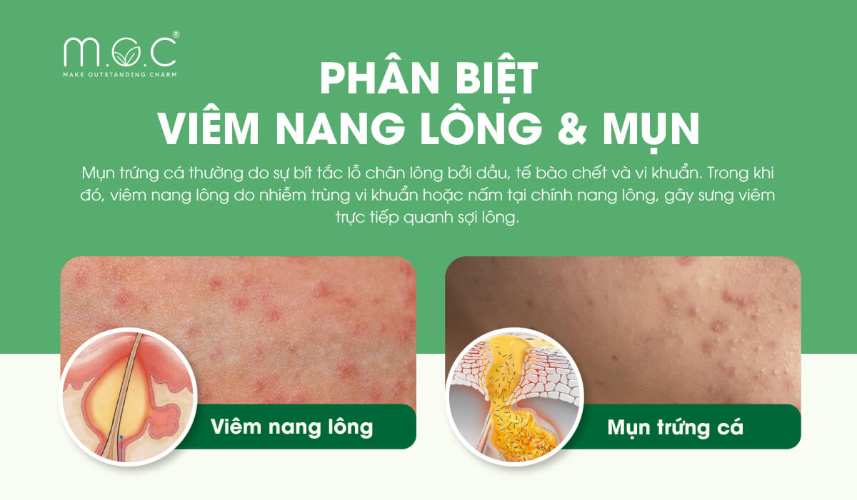 Phân biệt viêm nang lông và mụn