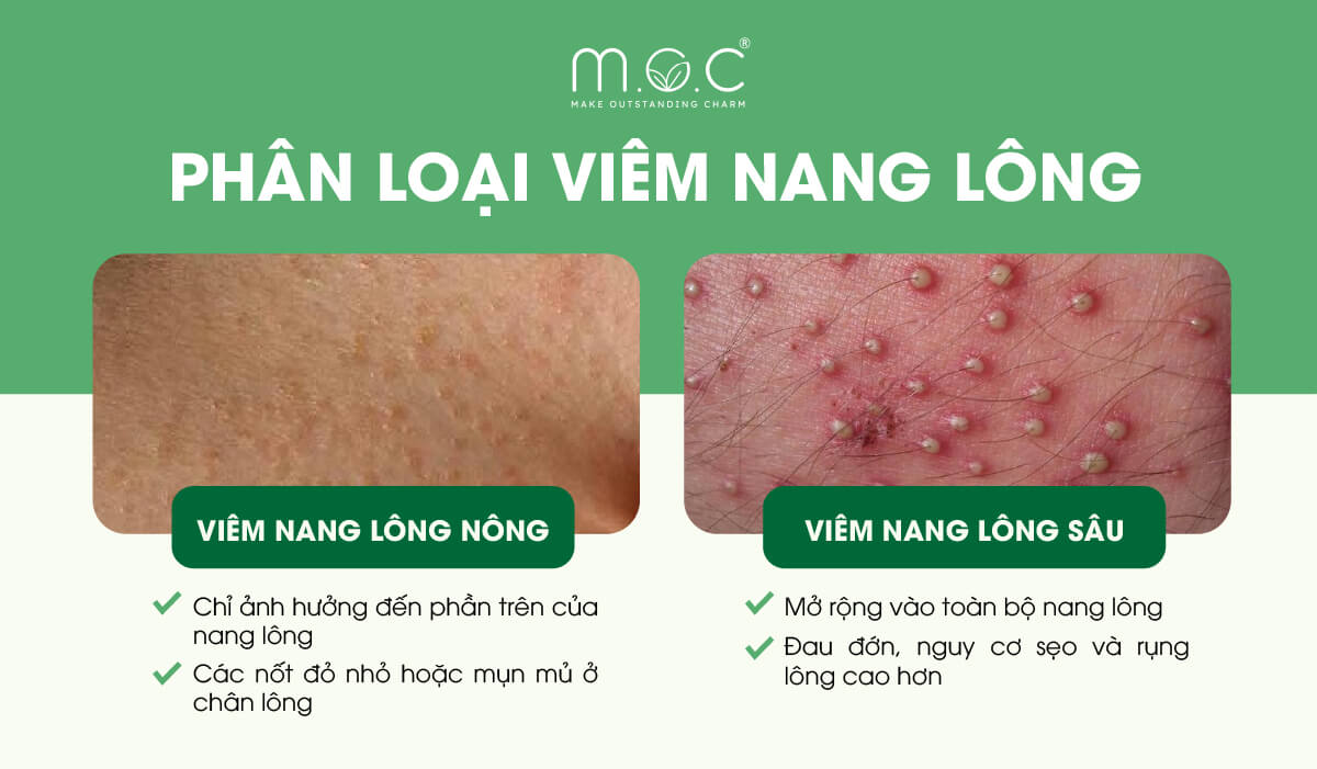 Phân loại viêm nang lông
