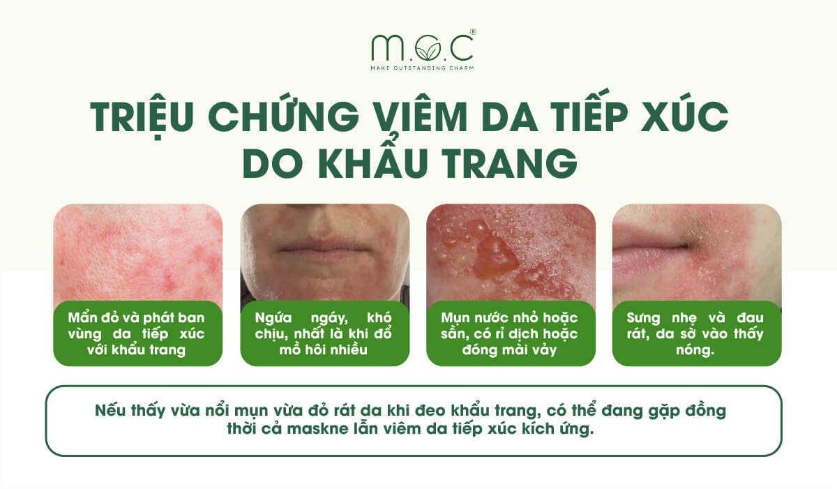 Những đặc điểm viêm da tiếp xúc do khẩu trang