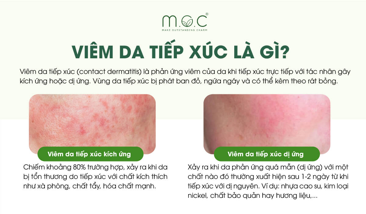 Viêm da tiếp xúc là gì?