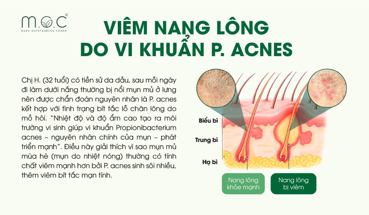 Viêm nang lông do vi khuẩn P. Acnes (tên gọi hiện tại là C. Acnes)