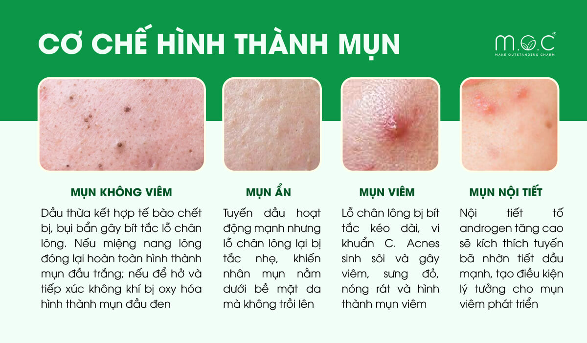 Cơ chế hình thành các loại mụn: Mụn đầu trắng/đen, Mụn ẩn, Mụn viêm