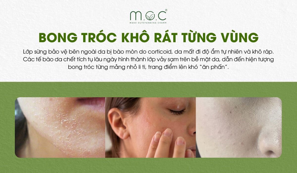 Bất lợi 3: Da nhiễm corticoid dễ khô rát, bong tróc mùa nắng