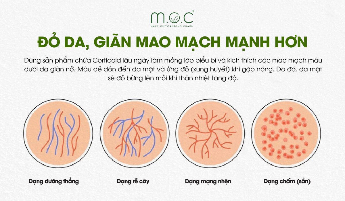 Bất lợi 1: Da nhiễm corticoid giãn mao mạch mạnh hơn vào mùa nắng