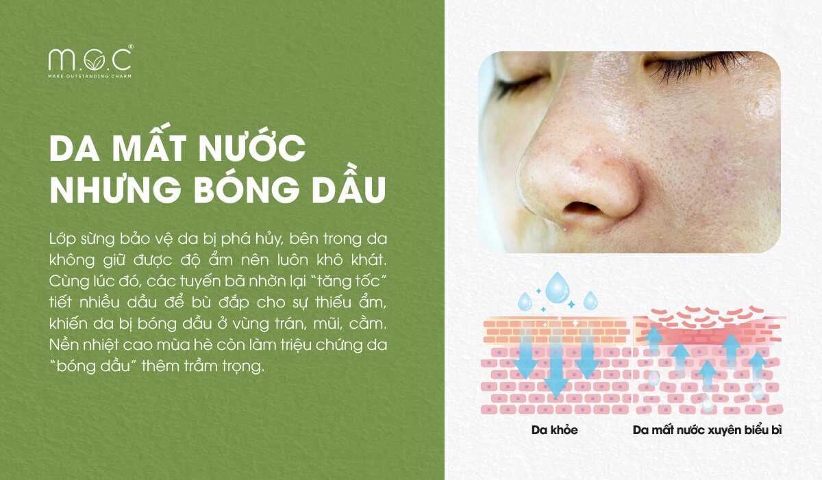 Bất lợi 5: Da nhiễm corticoid mất nước nhanh nhưng lại bóng dầu