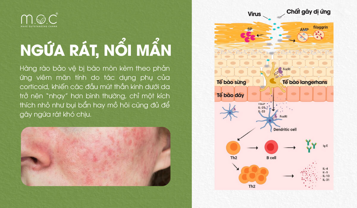 Bất lợi 2: Da nhiễm corticoid dễ ngứa rát, nổi mẩn mùa nắng