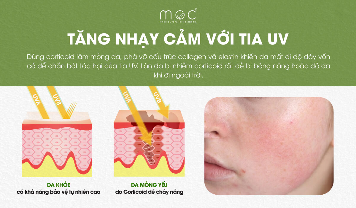 Bất lợi 8: Da nhiễm corticoid tăng nhạy cảm với tia UV
