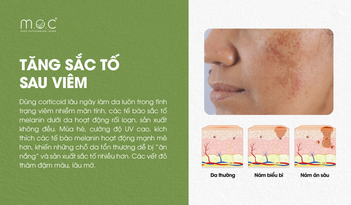 Bất lợi 4: Da nhiễm corticoid tăng sắc tố sau viêm mạnh mẽ