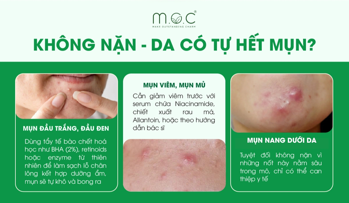 Mụn có tự hết nếu không nặn mụn không?