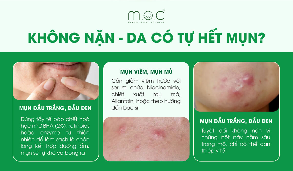 Mụn có tự hết nếu không nặn mụn không?