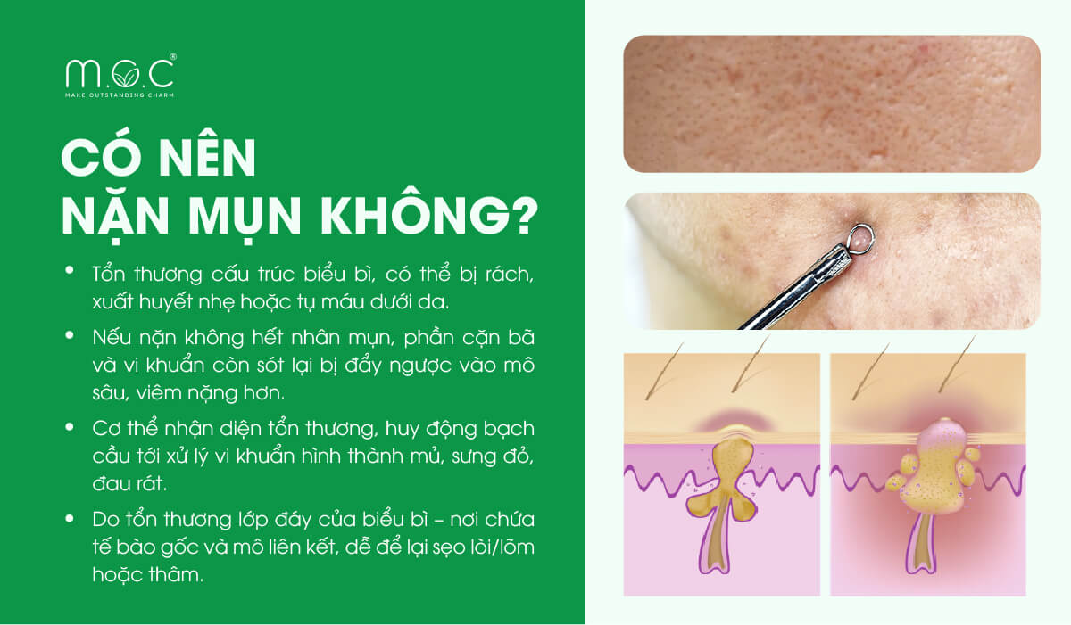 Nặn mụn tại nhà có nên không?