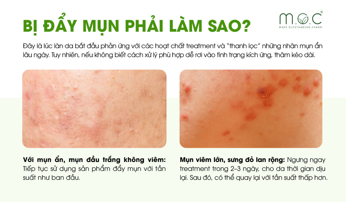 Bị đẩy mụn thì phải làm sao?
