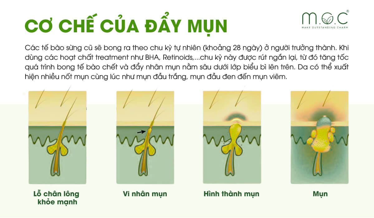 Cơ chế đẩy mụn ra sao?