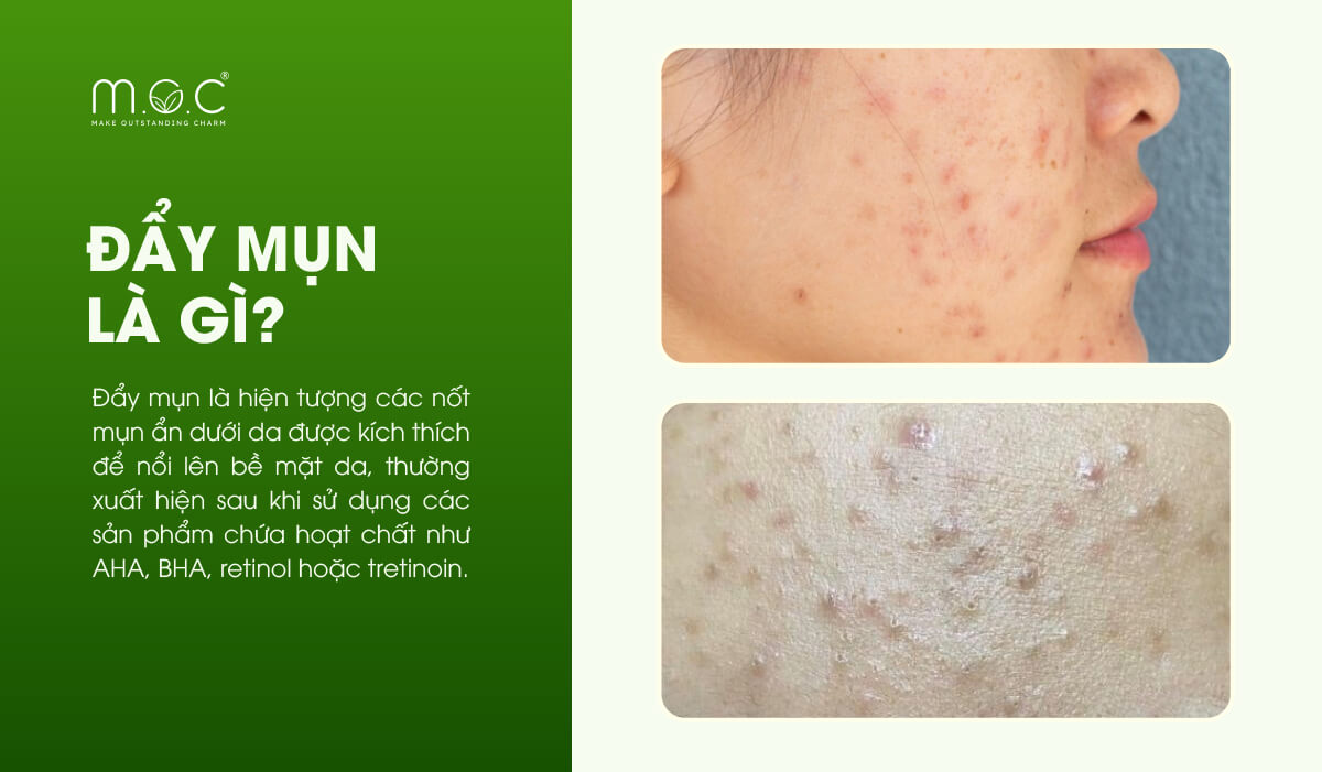 Đẩy mụn là gì?