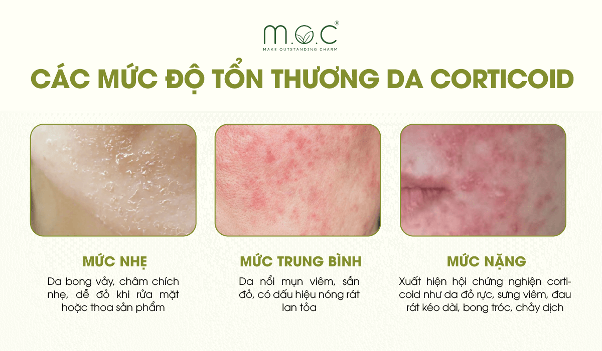 Các mức độ tổn thương da nhiễm Corticoid