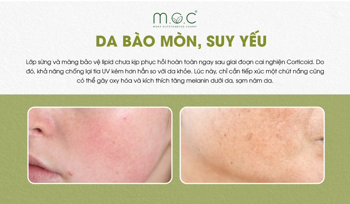 Da nhiễm Corticoid bị bào mỏn, mỏng yếu nên chỉ cần tiếp xúc tia UV dễ dẫn tới tăng sắc tố sau viêm (PIH) nhanh chóng