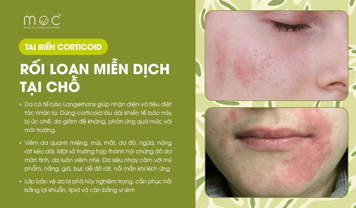 Tai biến da nhiễm Corticoid: Rối loạn miễn dịch tại chỗ