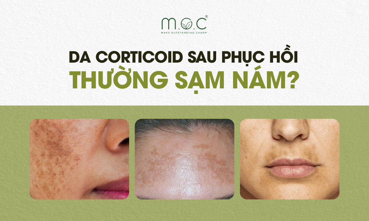 Da nhiễm Corticoid sau phục hồi thường sạm nám