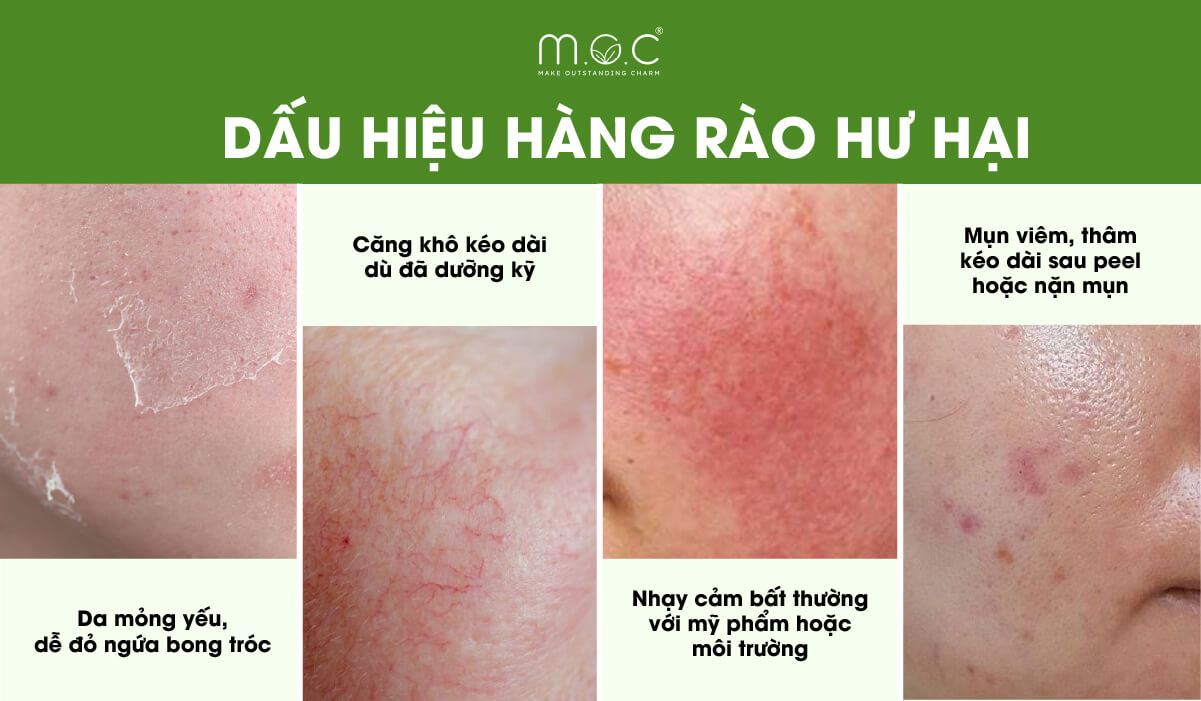 Những dấu hiệu cảnh báo hảng rào da hư hại