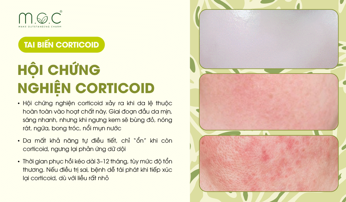 Tai biến da nhiễm Corticoid: Hội chứng nghiện Corticoid