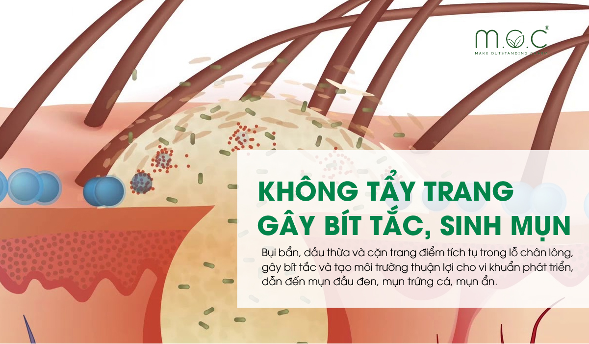 Không tẩy trang khiến dễ bít tắc cổ nang lông, sinh mụn