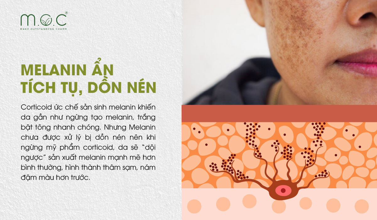 Melanin ẩn da corticoid sẽ “dội ngược” sản xuất mạnh mẽ sau khi ngừng ngang kem chứa Corticoid