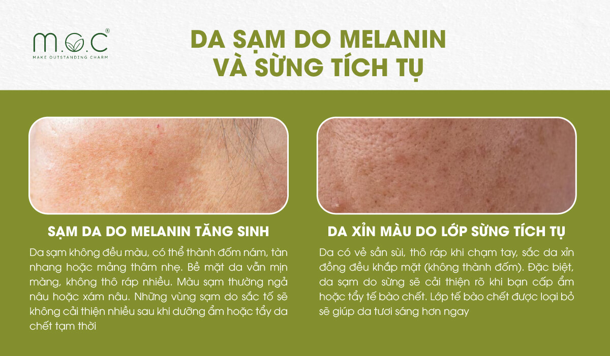 Phân biệt giữa sạm nám do Melanin và Sừng tích tụ trên da