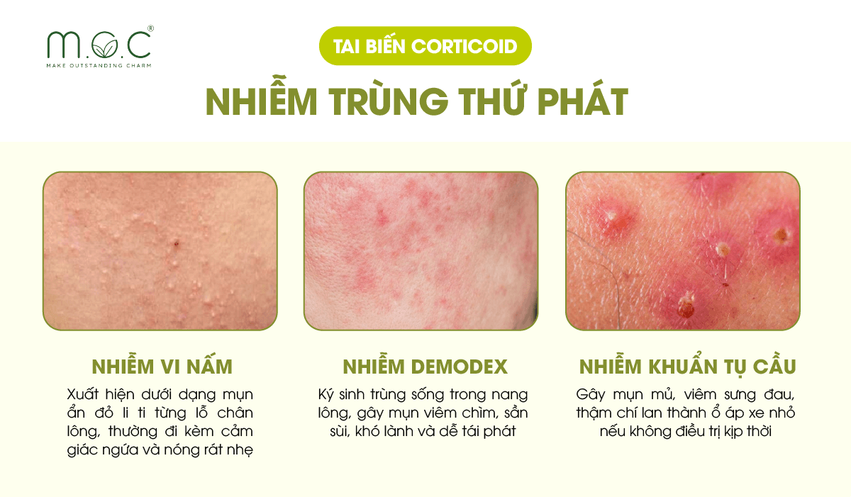 Tai biến da nhiễm Corticoid: Nhiễm trùng thứ phát