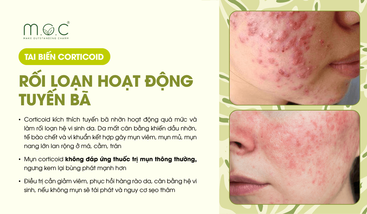 Tai biến da nhiễm Corticoid: Rối loạn hoạt động tuyến bã